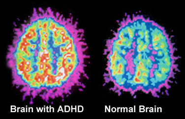 ACEclinics-ADD-ADHD-Clinic-Toronto-Assessment & Treatment | Learning Disability-Clinic-Toronto adhd-brain Conditions We Treat  